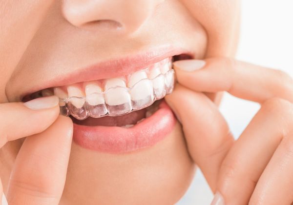 up close of woman putting in invisalign