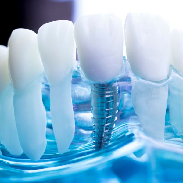 Choosing the Best Dental Implants in Minnesota 4.jpg