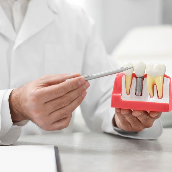 explaining how dental implants work