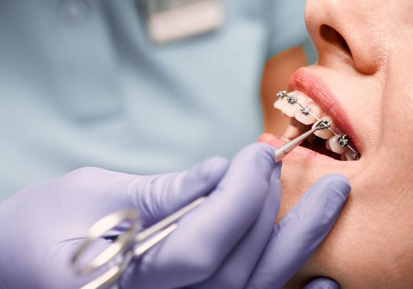 close up of teeth with braces at dentist