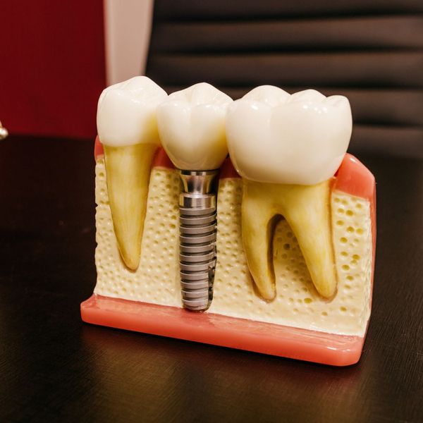 model of implant besides healthy teeth