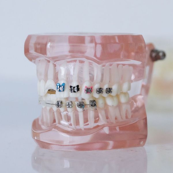 braces on a mouth model 