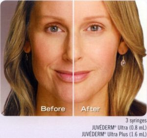 Vibeauty-dermal-filler-before-after-face-300x282.jpeg