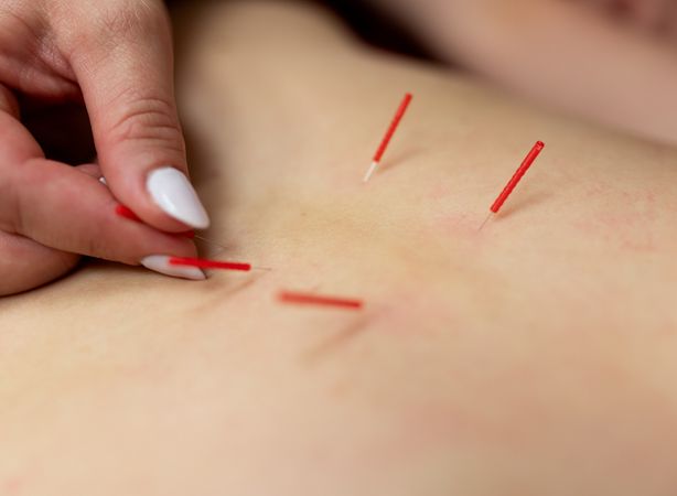 Dry Needling.jpg