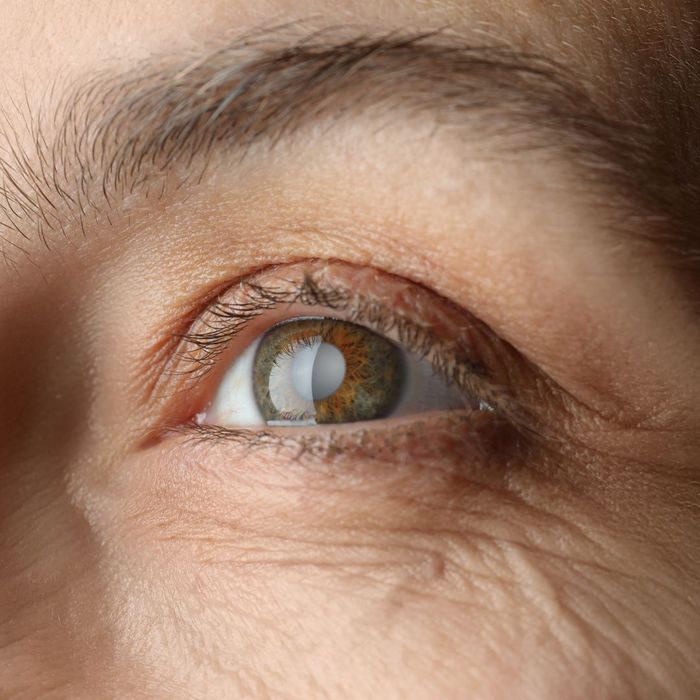 close up of a brown eye with cataracts