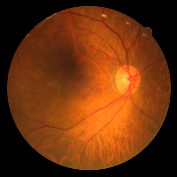 Photo Madical Retina Abnormal isolated on black background.Retina of diabetes diabates retinopathy.