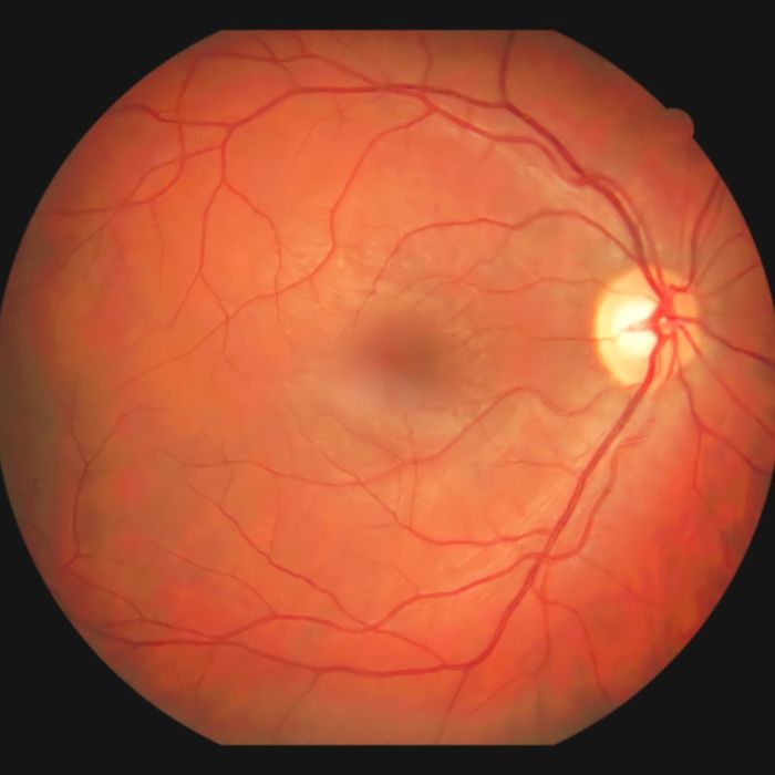 Inside view of an eyeball