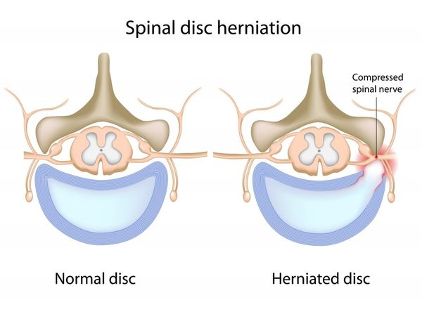 spinal-disc-herniation-62e9003521afe.jpg