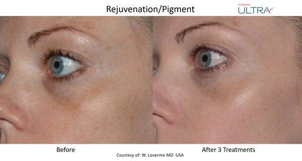 Ultra Loverme Rejuvenation Pigment 9.jpg