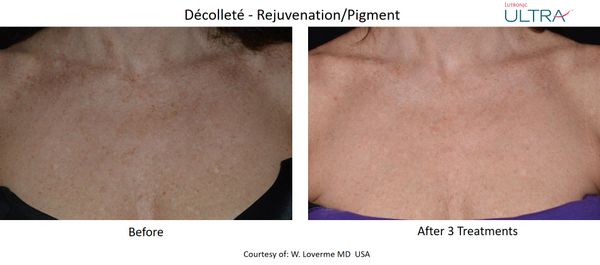 Ultra Loverme Rejuvenation Decolette 1.jpg