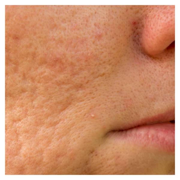 acne scarring. 