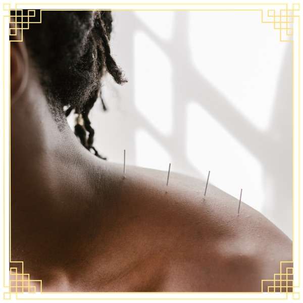 acupuncture on the shoulder/neck