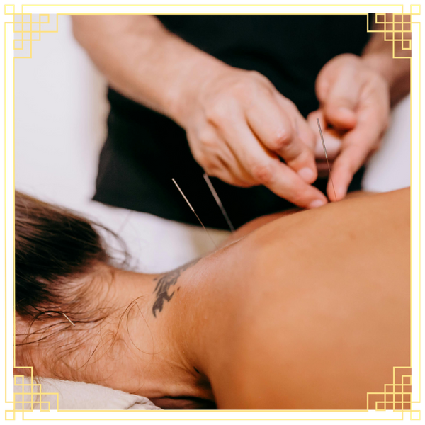 acupuncture on the back 