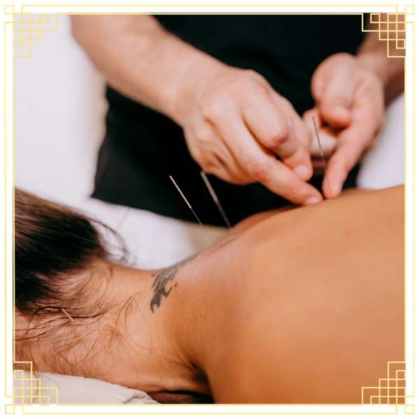 acupuncture on the back 