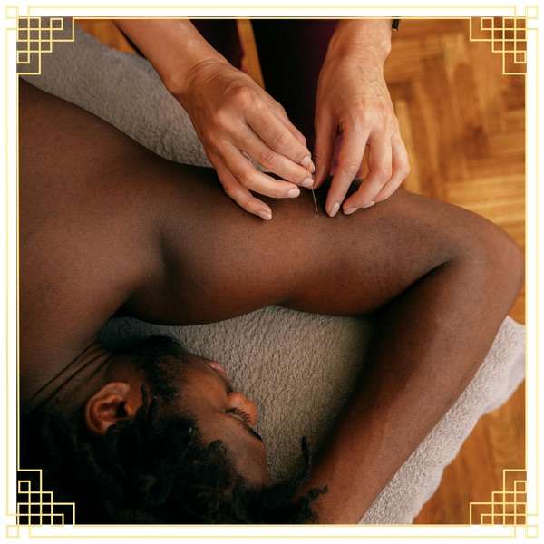 man receiving acupuncture