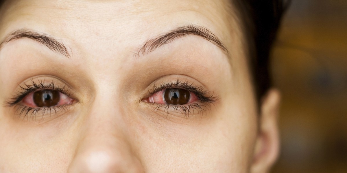image of a woman with dry eye