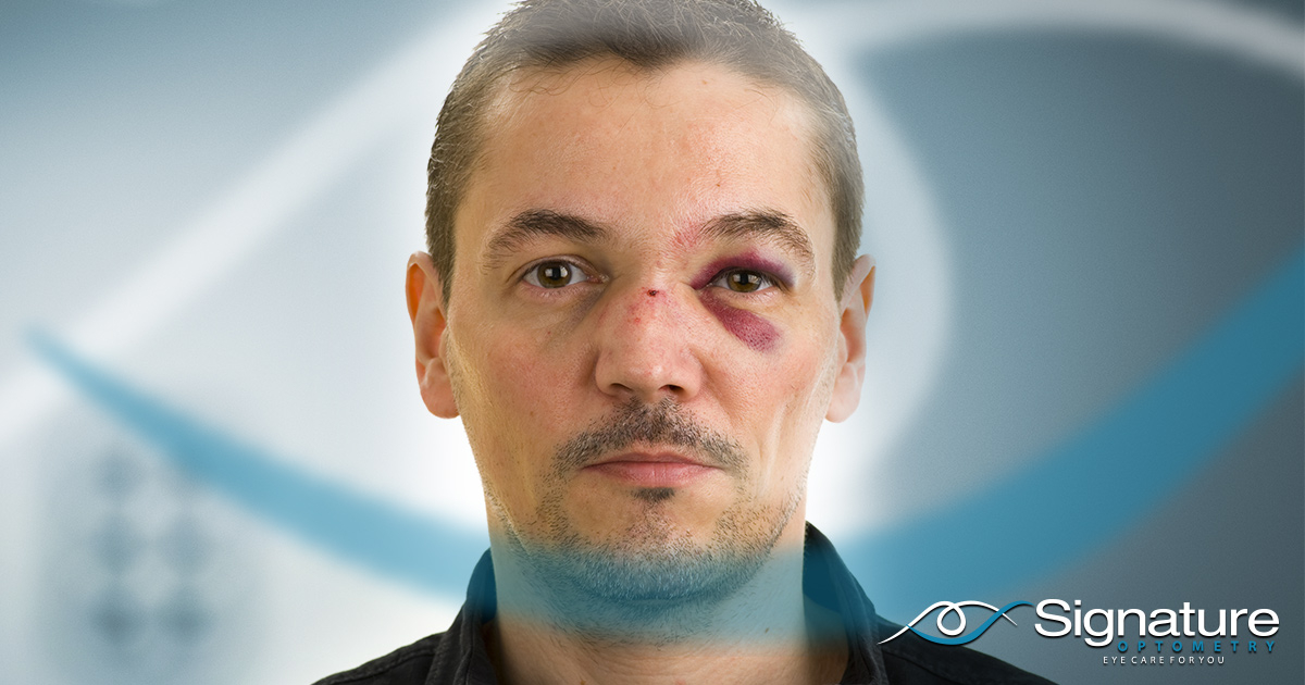 image of a man with a black eye