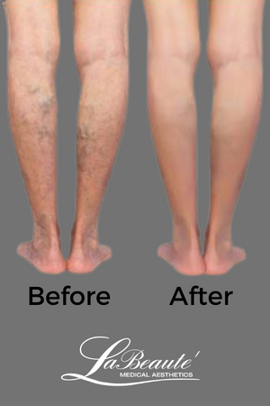 spider vein treatment in denver before and after.png