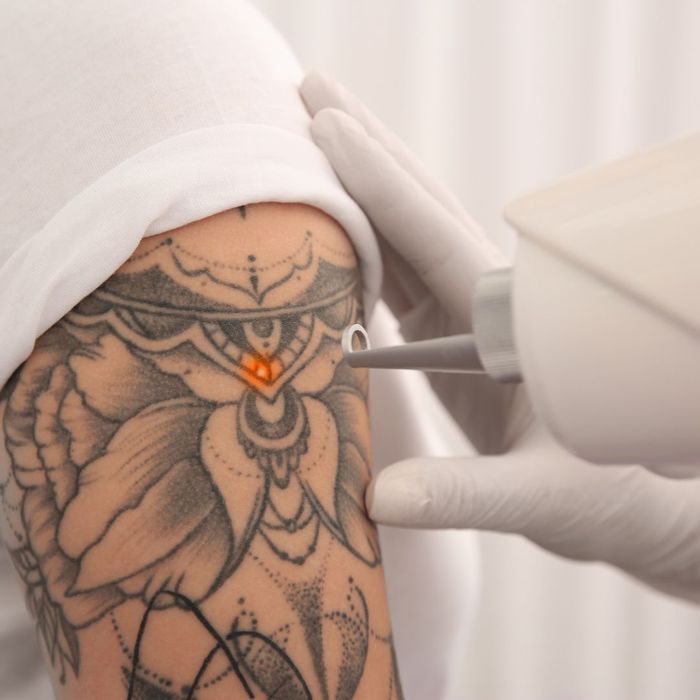 How to Prepare for Your Tattoo Removal-image2.jpg