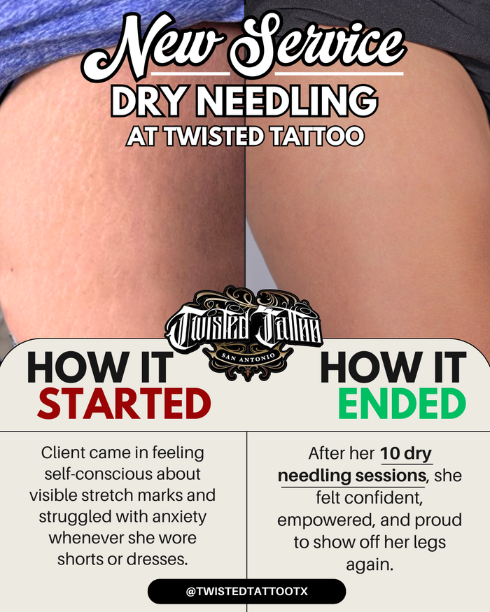 Dry Needling-2.png
