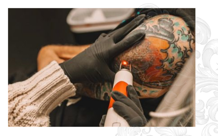 Laser Tattoo Removal PB Pic 4.png