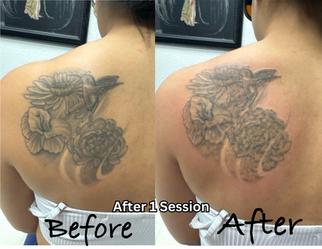 Laser Tattoo Removal | Twisted Tattoo