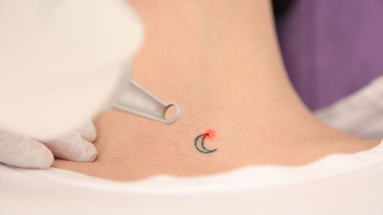 Person having a small moon tattoo removed
