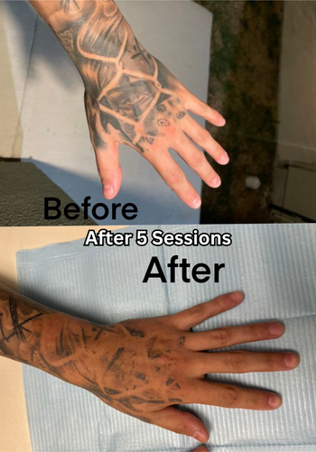 Laser Tattoo Removal | Twisted Tattoo