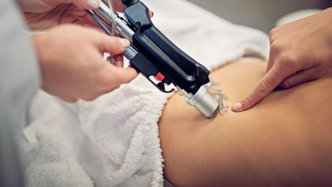Blog - M37163 Twisted Tattoo - Why Choose Twisted Tattoo For Your Laser Tattoo Removal - FEATURE.jpg