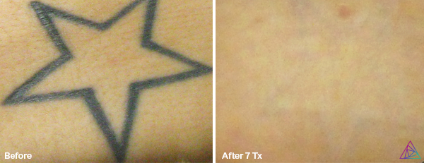 Laser Tattoo Removal | Twisted Tattoo