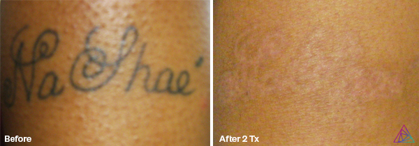 The Myths And Truths Of Laser Tattoo Removal  Fresh Skin Canvas