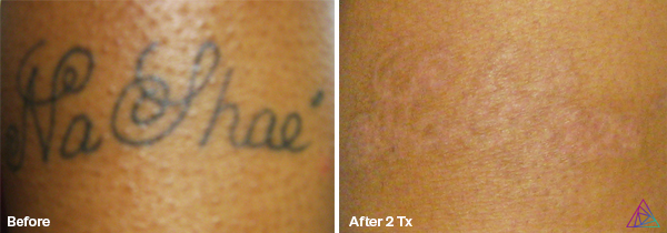 Laser Tattoo Removal | Twisted Tattoo