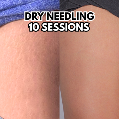 Dry Needling 10 Sessions.png