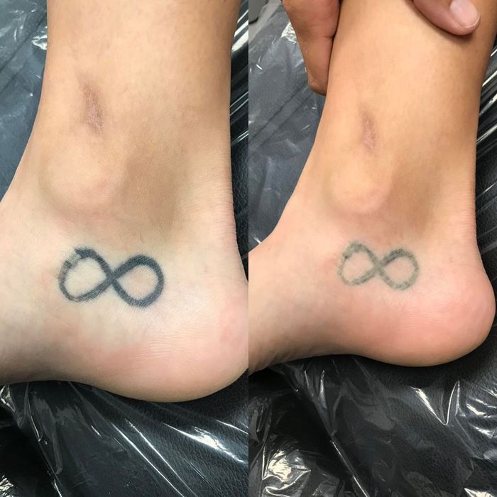 before_after of ankle tattoo removal.