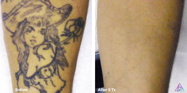 Laser Tattoo Removal | Twisted Tattoo