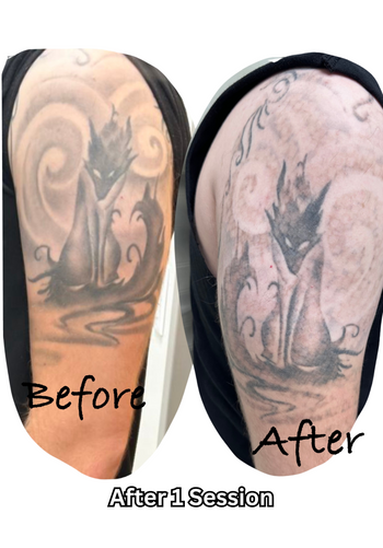 Laser Tattoo Removal | Twisted Tattoo