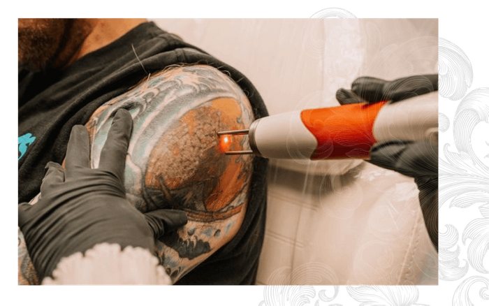 Laser Tattoo Removal PB Pic 2.png